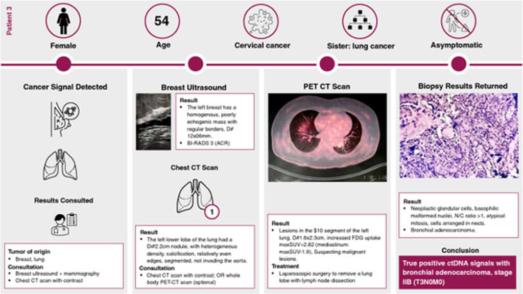 Figure 3. True positive case with stage IIB bronchial adenocarcinoma.